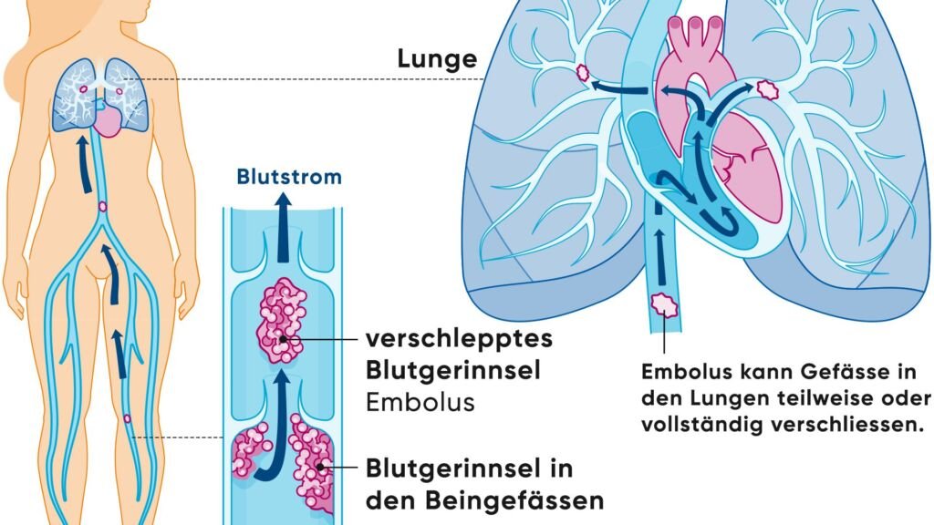 lungenembolie wie schnell stirbt man