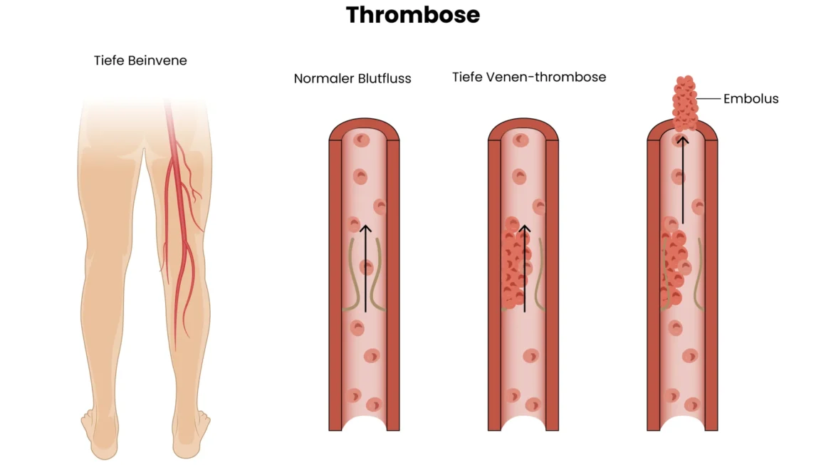 thromboseprophylaxe