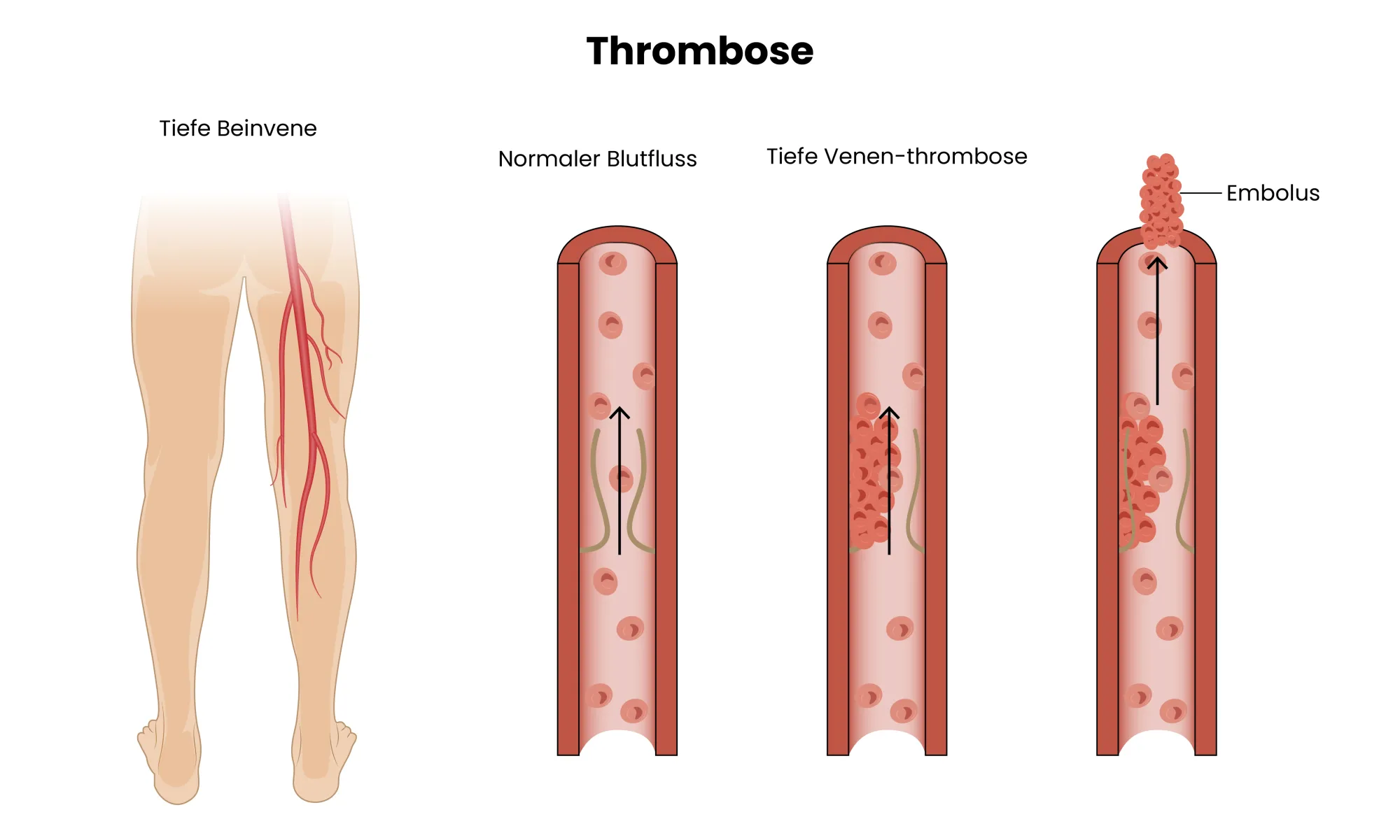 thromboseprophylaxe