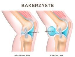 baker zyste